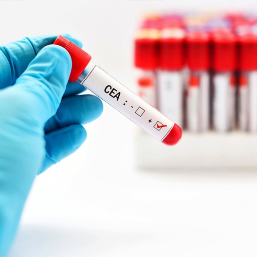 Carcinoembryonic Antigen (CEA)